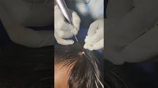 Wart on Scalp CO2 Laser Removal [upl. by Anemolihp496]