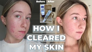 Adapalene Gel amp Benzoyl Peroxide transformation  skincare routine  HOW I CLEARED MY SKIN [upl. by Hayifas]