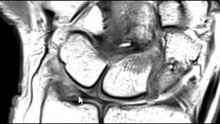 Triangular fibrocartilage TFCC tear [upl. by Fried]