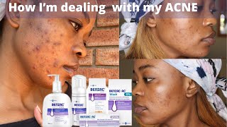 BENZOYL PEROXIDE Explained EVERYTHING How to use it Before and After Side Effects and More [upl. by Ardnot]