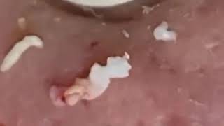 24  Blackheads Popping • Blackheads On Lips • Blackhead Removal Ear [upl. by Adyan111]