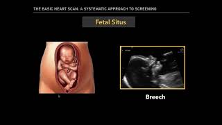 The Basic Fetal Heart Scan [upl. by Demp]