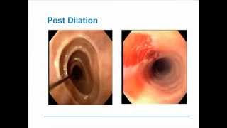 Eosinophilic Esophagitis [upl. by Jeannette]