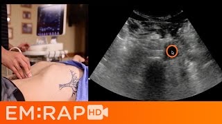 Coarctation of the Aorta treatment [upl. by Ellenij]