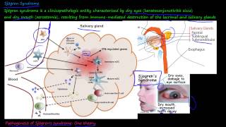 How To Pronounce Sjögrens Syndrome [upl. by Annez]