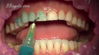 Prepless Veneers Permanent Teeth Whitening [upl. by Rooney]