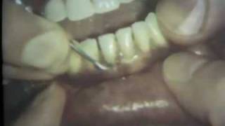 Scaling and Root Planing Part II Mandibular Teeth [upl. by Fauver]