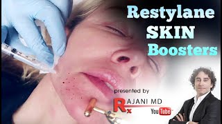 Restylane Skin Boosters [upl. by Itram]