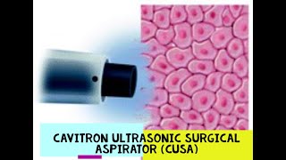 CAVITRON ULTRASONIC SURGICAL ASPIRATOR  CUSA [upl. by Rednasela]