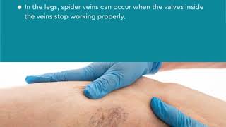 Medical Clinic How To Remove Varicose Veins explained  Vein Treatment Center New York 10017 [upl. by Marshal854]