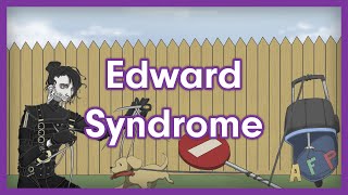 Edward Syndrome Trisomy 18  USMLE Step 1 Mnemonic [upl. by Aisatal]