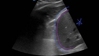 POCUS  Lung Ultrasound Understanding B Lines and Hepatization [upl. by Philly]