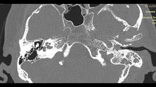 How to Read HRCT Temporal Bone  All Basics in Detail [upl. by Childs]