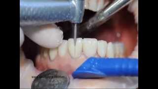 Procera veneers removal [upl. by Tiffy]