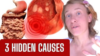 The Hidden Truth What REALLY Causes Gastritis SURPRISE [upl. by Cassaundra]