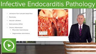 Infective Endocarditis IE Pathology – Infectious Diseases  Lecturio [upl. by Agathe]