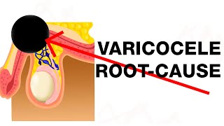 Varicocele Treat the RootCause [upl. by Rovner]