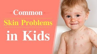 Skin Rash Causes Signs and Symptoms Diagnosis and Treatment [upl. by Wakefield49]