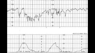 Fetal Monitoring Segment 4 Fetal Heart Decelerations [upl. by Marie]