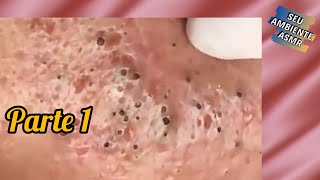 Retirando Cravos Pretos e Profundos  Comedões Parte 1 Acne Treatment  Vídeo Satisfatório  059 [upl. by Eniar]