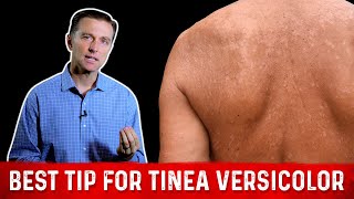 Natural Skin Fungus Tinea Versicolor Home Remedies – Dr Berg [upl. by Aizek]