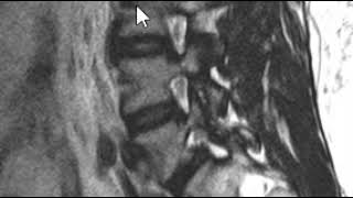 Lumbar Spine MRI  Pars Defect [upl. by Jan]