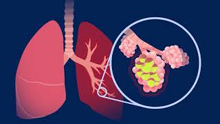 Understanding Pneumococcal Pneumonia [upl. by Saum]