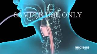 Upper Gastrointestinal Endoscopy EGD [upl. by Ennayk]