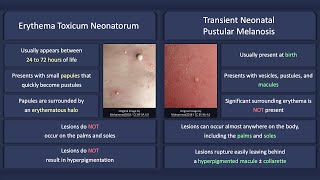 Erythema Toxicum Neonatorum vs Transient Neonatal Pustular Melanosis [upl. by Lucky]