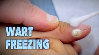 FREEZING WARTS With Sizzling Liquid Nitrogen  Dr Paul [upl. by Stalk]