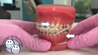 Elastics in Orthodontics  Overview [upl. by Trebloc]