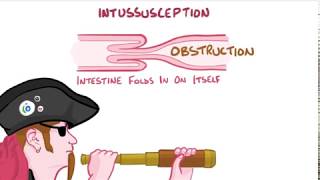 intussusception [upl. by Assereht]