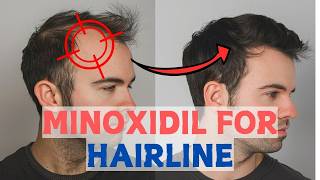 Minoxidil for Frontal Baldness  Restore Your Hairline [upl. by Zaria]