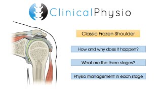 Classic Frozen Shoulder  Clinical Physio [upl. by Dnalyaw534]