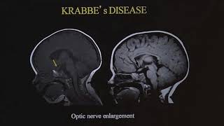 TMT Neuroradiology by Dr Deepak Patkar Ped White Matter Diseases  II [upl. by Aidni440]