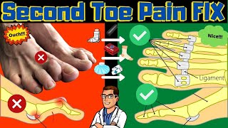 Second Toe Pain TREATMENT Capsulitis Taping amp Freiberg Disease FIX [upl. by Zullo628]