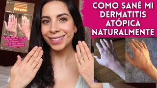 Como Sané mi Dermatitis Atópica sin Medicamentos y de Forma Natural [upl. by Airekat]