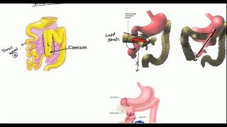 Gut Malrotation Nonrotation and Volvulus for USMLE [upl. by Shelly]