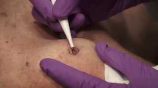 Watch amp Learn Electrosurgery [upl. by Enahpets]