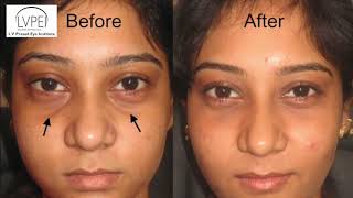 Under Eye Fillers [upl. by Leonardo]