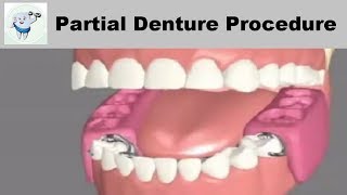 Removable Partial Dentures Steps [upl. by Zaob647]