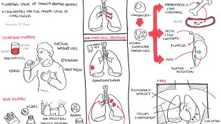 Lung Cancer  Overview [upl. by Atsyrhc]