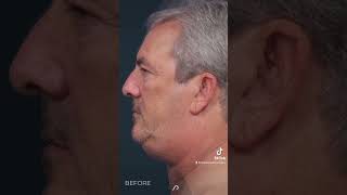 Watch the Incredible Results Neck Lift amp Liposuction Transformation [upl. by Clem]