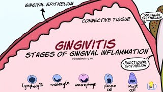 Gingivitis Stages of Gingival Inflammation [upl. by Enitsej]