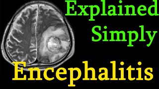 Encephalitis  brain inflammation  Symptoms causes prognosis Treatment explained simply [upl. by Dannica]