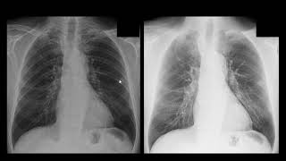 Nódulo pulmonar não calcificado [upl. by Letti]