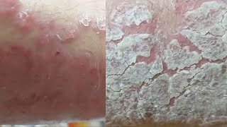 EXTREME REGENERATION 1 WEEK AFTER FULL CLEANING Psoriasis [upl. by Blinnie]