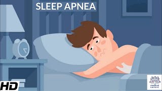 Five Exercises for Snoring and Sleep Apnoea Updated [upl. by Dlanigger]