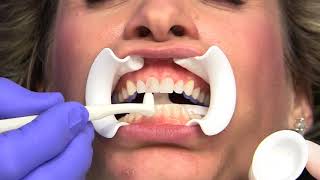 Lumineers® Placement StepbyStep  DenMat Dental Education [upl. by Veronika]