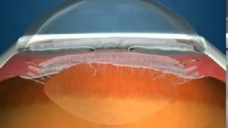 How Fluid Circulates in the Eye [upl. by Delbert]